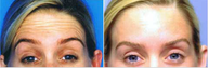Botox