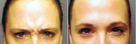 Botox