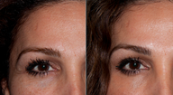 Botox