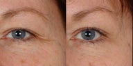 Botox