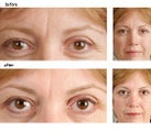  Botox for Frown Lines
