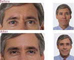 Botox for Frown Lines