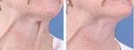  Botox for Neck bands