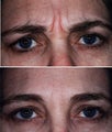  Showing Expression Before and After Botox