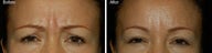 Botox