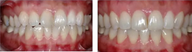 Orthodontic Braces - Crooked Teeth 