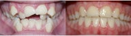 Braces