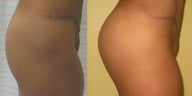 Buttock Augmentation with Natural Fat