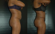 Brazilian Butt Lift