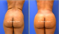 Brazilian Buttock Lift