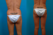 Brazilian Butt Lift