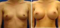Breast Augmentation