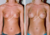 Breast Augmentation