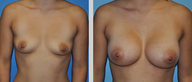 Flash Recovery Breast Augmentation TM