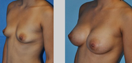 Flash Recovery Breast Augmentation TM