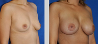 Flash Recovery Breast Augmentation TM