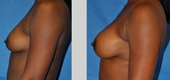 Flash Recovery Breast Augmentation TM