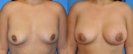 Flash Recovery Breast Augmentation TM