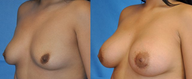 Flash Recovery Breast Augmentation TM