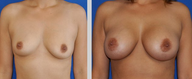 Breast Augmentation