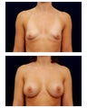Breast Augmentation