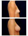 Breast Augmentation