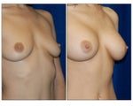 Breast Augmentation