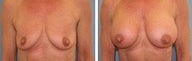 Breast Augmentation
