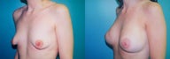 Tuberous Breast Correction - Biplanar Augmentation 