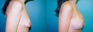 Tuberous Breast Correction - Biplanar Augmentation
