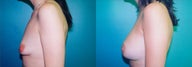 Tuberous Breast Correction - Biplanar Augmentation