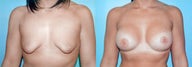 Tuberous Breast Correction - Biplanar Augmentation