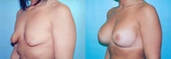 Tuberous Breast Correction - Biplanar Augmentation