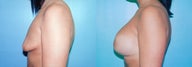 Tuberous Breast Correction - Biplanar Augmentation
