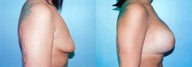 Tuberous Breast Correction - Biplanar Augmentation