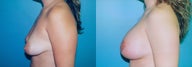 Tuberous Breast Dual Plane Augmentation + Periareolar Mastopexy