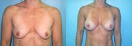 Dual Plane Breast Augmentation