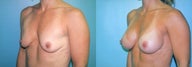 Dual Plane Breast Augmentation