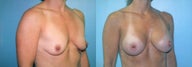 Dual Plane Breast Augmentation