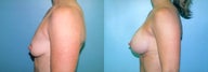 Dual Plane Breast Augmentation