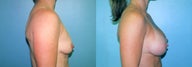 Dual Plane Breast Augmentation
