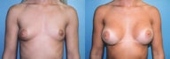 Breast Augmentation & Areola Reduction