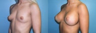 Breast Augmentation & Areola Reduction