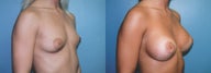 Breast Augmentation & Areola Reduction