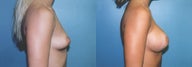 Breast Augmentation & Areola Reduction