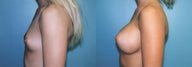 Breast Augmentation & Areola Reduction