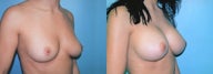 Differential Breast Augmentation Using Silicone Implants