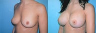 Differential Breast Augmentation Using Silicone Implants