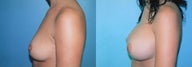 Differential Breast Augmentation Using Silicone Implants