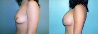 Breast Augmentation